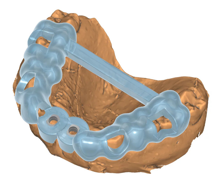 Guide-Creator-module-Exoplan-Polyfab3D-Dental